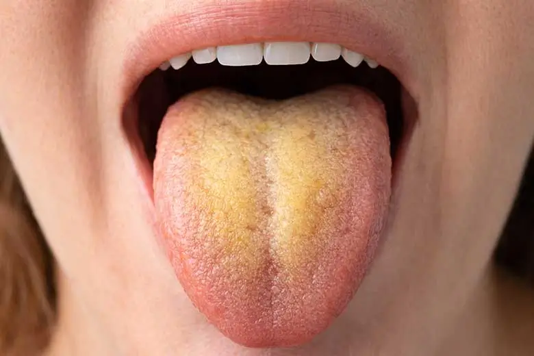 Dil Sararması Neden Olur? Sarı Tabakanın Sebepleri Neler?