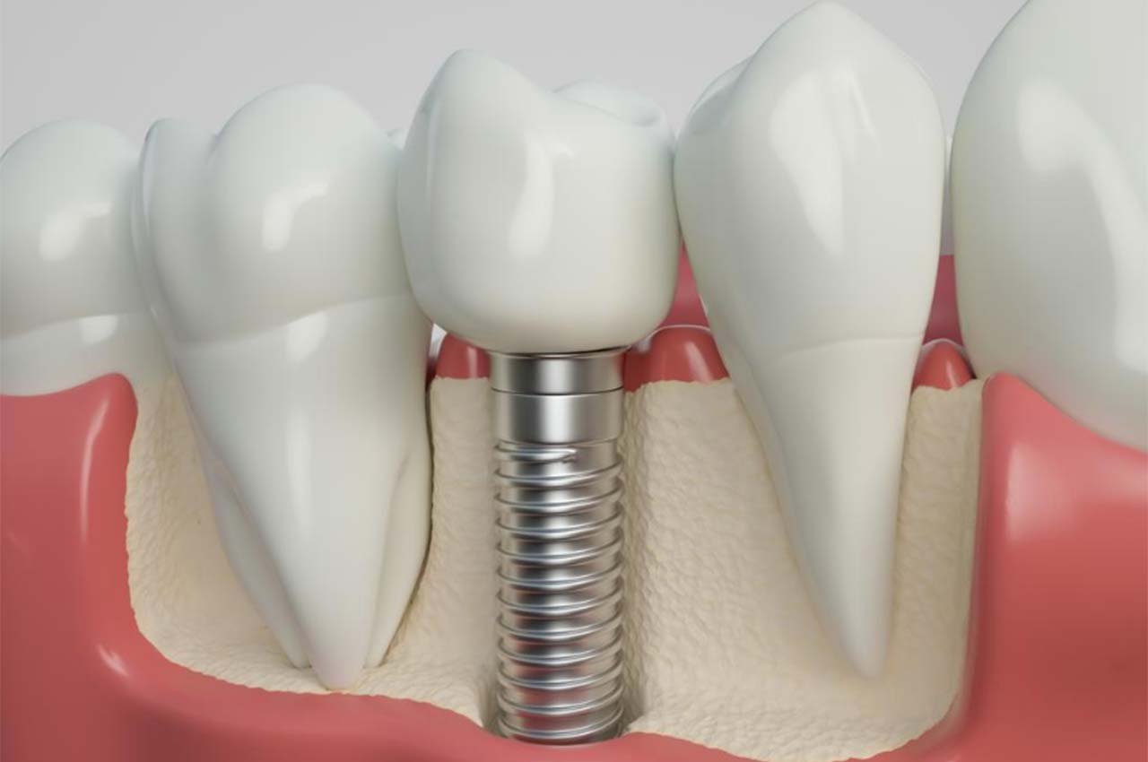 Başarısız İmplant Belirtileri ve İmplant Sonrası Bilinmesi Gerekenler