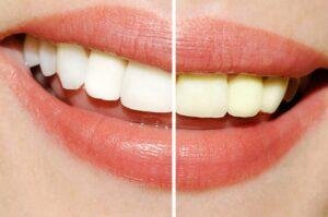 Diş beyazlatma sonrası sararma, beyazlatma sonrası dişler neden sararır?