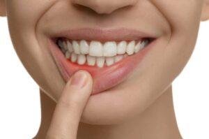 Agresif Periodontitis Nedir? Agresif Periodontitis Sebepleri, Agresif Periodontitis belirtileri ve tedavisi