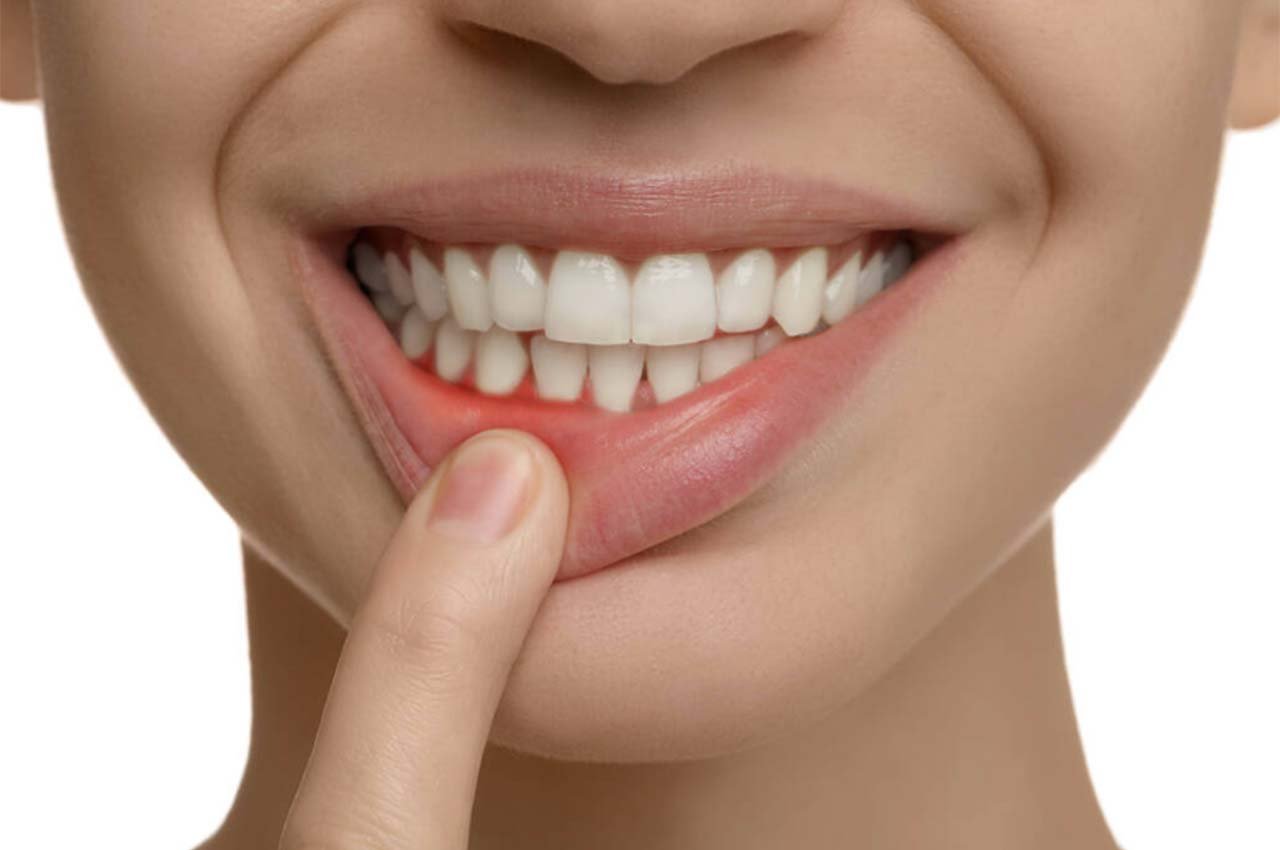 Agresif Periodontitis Nedir?