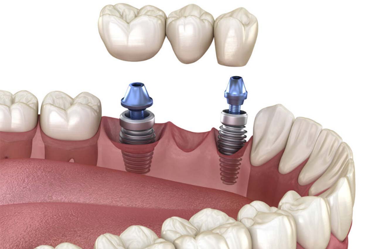 implant tedavisi, implant tedavisi nedir, süresi, nasıl yapılır? implant tedavisi sonrası